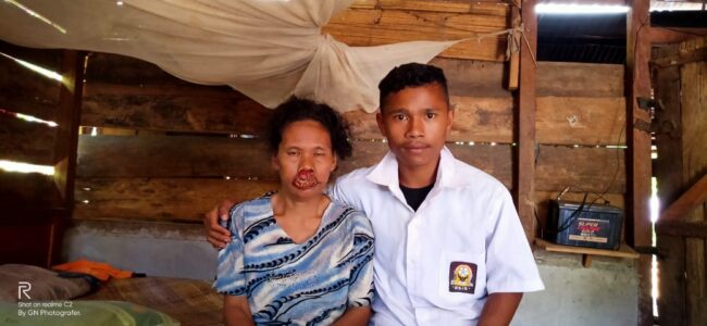 matim bibir sumbing
